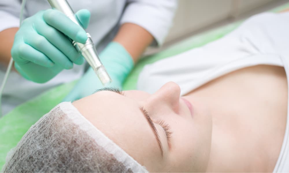 Microneedling Behandlung
